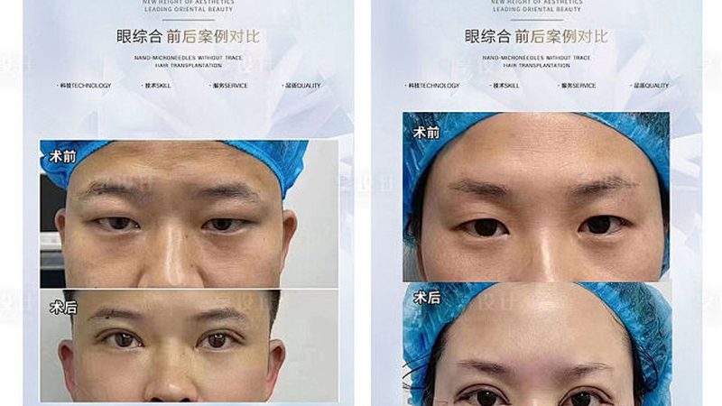 敏感肌能否用光子嫩肤仪：揭秘安全与适用性