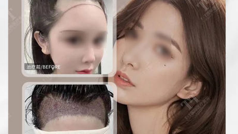 自体软骨隆鼻：揭秘费用构成与选择要点