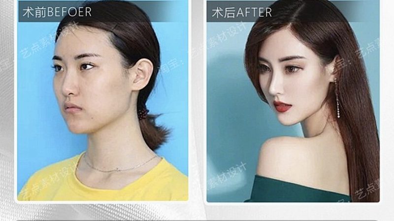 双眼皮术后，冷敷还是热敷？正确时间你了解吗？**