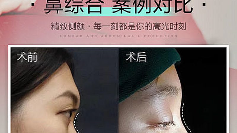 激光祛雀斑后多久恢复？揭秘恢复期关键因素