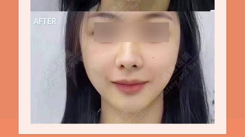 蛋白线面部提升，揭秘其神秘步骤