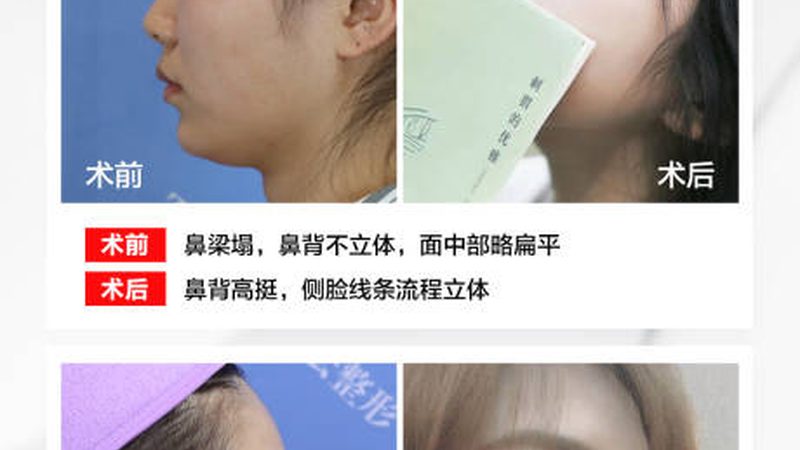 注射隆鼻，安全风险如何把控？**