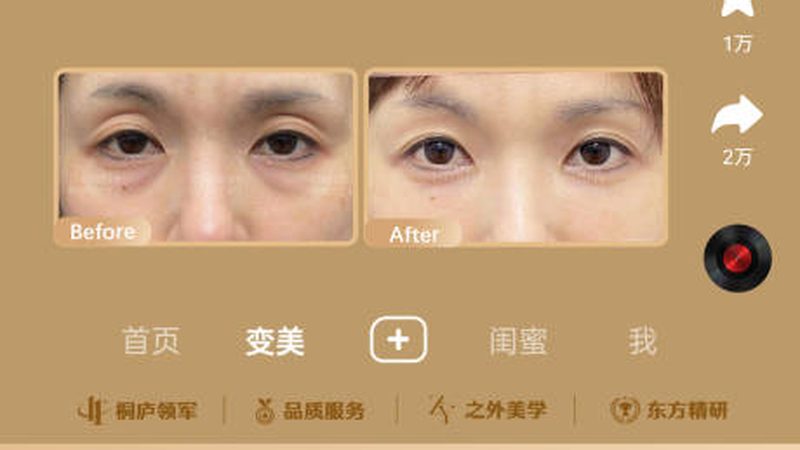 热玛吉2025：揭秘热玛吉价格背后的选购秘诀