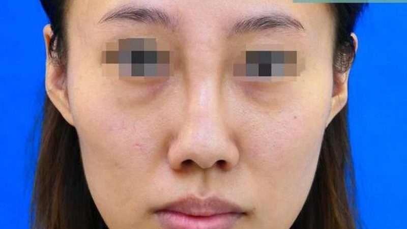 自体脂肪隆胸：杭州手术流程揭秘，恢复期全解析